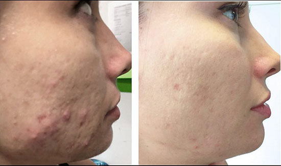 Pepfactor skin clearing after 6 weeks